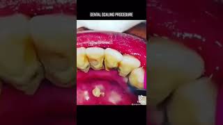 Dental plaque removal || Oddly satisfying videos