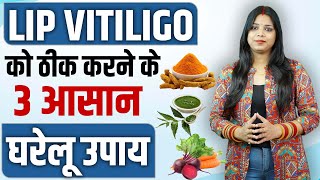 Lip Vitiligo के घरेलू उपाय : सफेद दागों का इलाज | Vitiligo Kya Hota Hai | Lip Tip Vitiligo Treatment