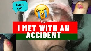 I MET WITH AN ACCIDENT| Ntorq Crashed| HOW PHYSIOTHERAPY HELPED ME RECOVER