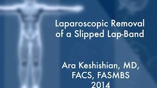 Laparoscopic Removal of a Slipped Band