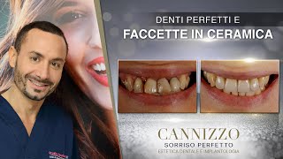 Cannizzo Studio - Faccette Dentali in Ceramica