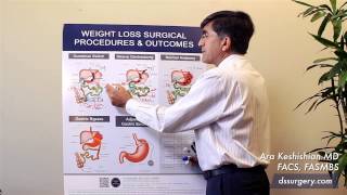 Weight Loss Surgical Procedures Part 4 - Duodenal Switch