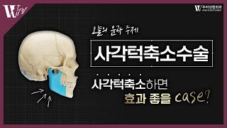 사각턱축소수술 효과가 좋은 CASE : 윤곽 케이스 분석