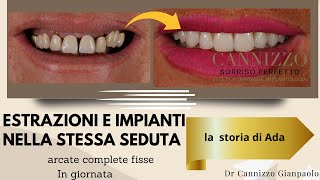 ALL ON FOUR - impianti dentali