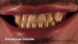 Faccette dentali di alta qualità!