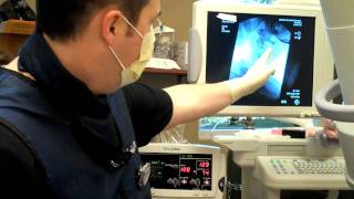 Cervical Radio Frequency Ablation