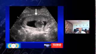 Imaging Features of Retained Products of Conception