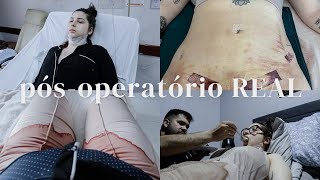 OS PRIMEIROS 10 DIAS DE PÓS-OPERATÓRIO COMIGO: lipoescultura + mastopexia + enxerto nos glúteos 😱