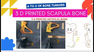 3 D Printing Scapula Artificial Titanium joint to replace Cancer bone scapula or shoulder bone