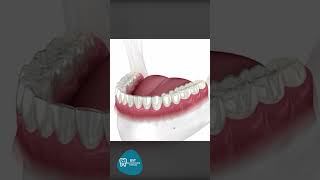 İnvisalign Şeffaf  Plak Tedavisi Nasıl Yapılır?  #smiledesignturkey #dentaltreatments