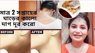 How to remove dark neck easily and permanently । ঘাড়ের ওপর কালো দাগ দূর করো মাত্র দুই সপ্তাহে।