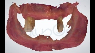 Intraoral scans of double edentulous arches: automatic alignment.