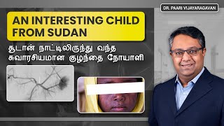 An Interesting Child Patient from Sudan | சூடான் நாட்டிலிருந்து வந்த சுவாரசியமான குழந்தை நோயாளி