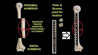 Humerus Ewing's Sarcoma surgery with ECRT or Extracorporeal radiotherapy