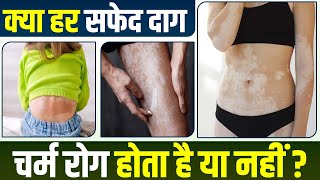 Vitiligo (चर्म रोग) को कैसे पहचाने | How To Recognize White Spots (Skin Disease) | Vitiligo Symptoms