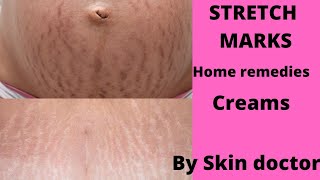 stretchmarks removal/ home remedies/ creams/வரிதழும்புக்கு தீர்வு மருத்துவர் விளக்கம்