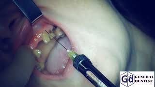 Infiltration anesthesia for implantation 22.