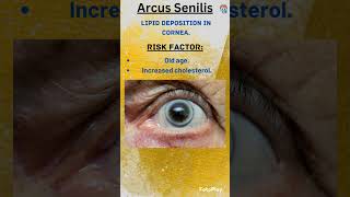 Lipid deposition in eye(ARCUS SENILIS).