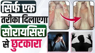 Cure psoriasis permanently | Psoriasis homeopathy in hindi | Only one treatment to cure psoriasis