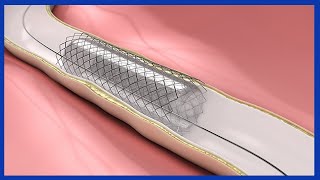 Carotid Artery Stenting