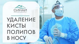 👃Удаление кисты, полипа носа с помощью эндоскопа, видео операции. Удаление кисты носа эндоскопом.12+