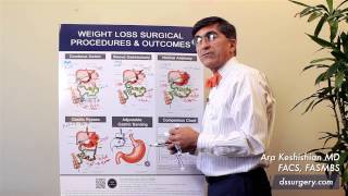 Weight Loss Surgical Procedures Part 6 - Gastric Bypass