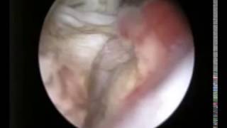 Hysteroscopic Myomectomy