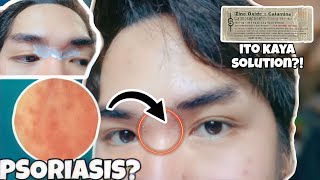 MABISANG SOLUSYON SA PSORIASIS?!😱 NAPAKA EFFECTIVE NG OINTMENT NA ITO!❤️