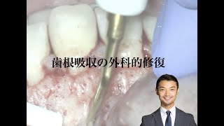 Surgery: External root resorption 歯根吸収の外科的修復