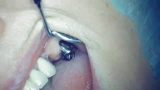 Infiltration anesthesia technique for implantation missing 26 teeth.