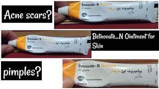 Betnovate_N Ointment  for Skin ||Review ||FOR pimples pigmentation & dark spots