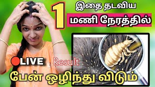 😱Just 1 time பேன் (lice)ஒழிந்து விடும் 😍 best effective remedy for lice and nits 👌👍