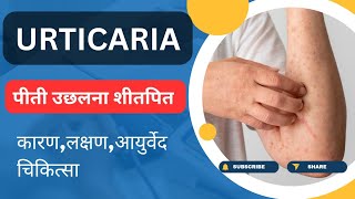 Urticaria -पीती उछलना Vs आयुर्वेद।लक्षण।चिकित्सा।परहेज । #ayurvedic #urticaria #allergies