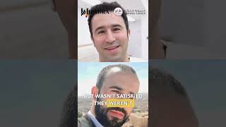 نتيجة زراعة الشعر بعد ٦ شهور #hairtransplant #beforeandafter #زراعة_شعر #dubai #دبي