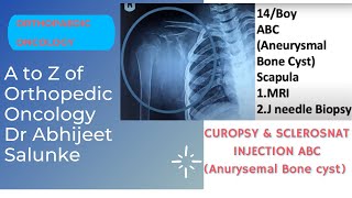 Aneurysmal bone cyst (ABC) Bone tumor : Polidocanol Sclerosant injection treatment