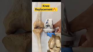 knee Replacement || #Shorts#knee#tranding#shortsvideo