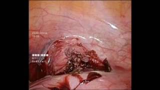 laparoscopic cerclage