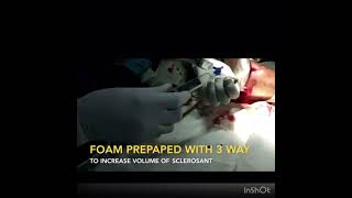 Anurysemal Bone Cyst Minimal Invasive treatment with Polidocanol Injection