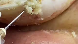 Best Acne Popping