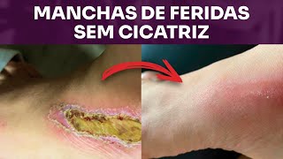 Manchas de queimadura, feridas e machucados tratados com Óleos Essenciais sem cicatriz