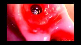 #shorts|abutment screw fracture ICX.  Massive C 011 0000011 .