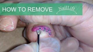 How to Remove NailLift for Practitioners