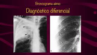 Opacidades alveolares