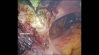 laparoscopic hysterectomy