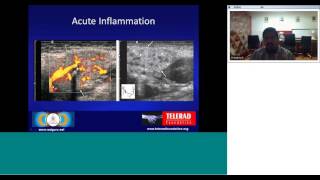 Ultrasound of the salivary glands by Dr Prasanna.R