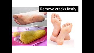 Tips to remove cracks in feet | Starnaturalbeauties