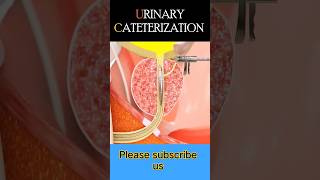 #urineproblem #urineproblems #catheterization #shortsvideo #labtech #trendingvideo #mbbslove #doctor