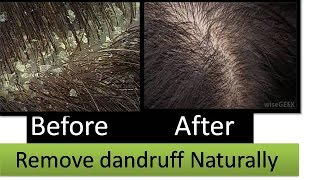 Remove dandruff at home |How to remove dandruff quickly & naturally | StarNaturalBeauties