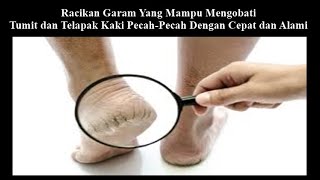 Mengobati Tumit dan Telapak Kaki Pecah Pecah Dengan Cepat dan Alami