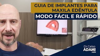 COMO CRIAR UM GUIA PARA IMPLANTES UTILIZANDO AS PRÓTESES TOTAIS DO PACIENTE E IMPRESSÃO 3D